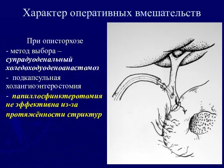 Характер оперативных вмешательств При описторхозе - метод выбора – супрадуоденальный