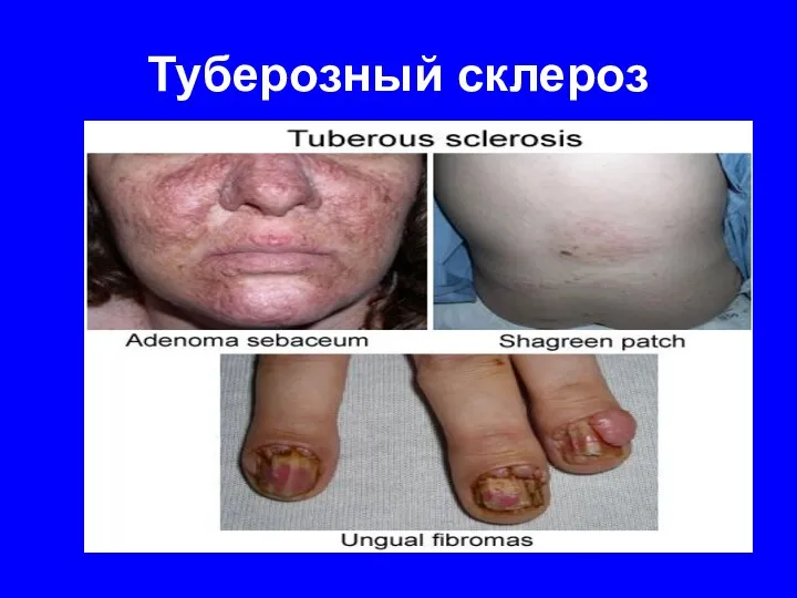 Туберозный склероз