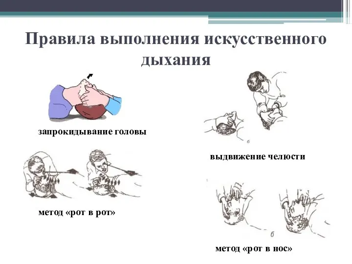 Правила выполнения искусственного дыхания метод «рот в рот» метод «рот в нос» запрокидывание головы выдвижение челюсти