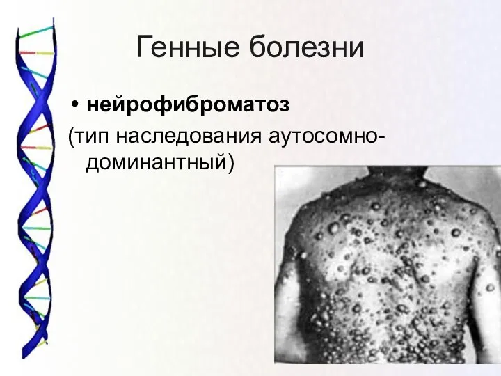 Генные болезни нейрофиброматоз (тип наследования аутосомно-доминантный)