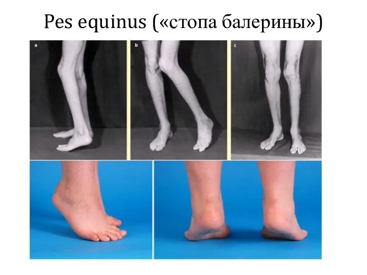 Pes equinus («стопа балерины»)