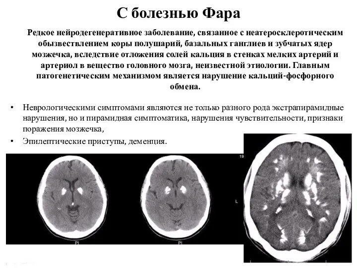 С болезнью Фара Редкое нейродегенеративное заболевание, связанное с неатеросклеротнческим обызвествлением коры полушарий, базальных