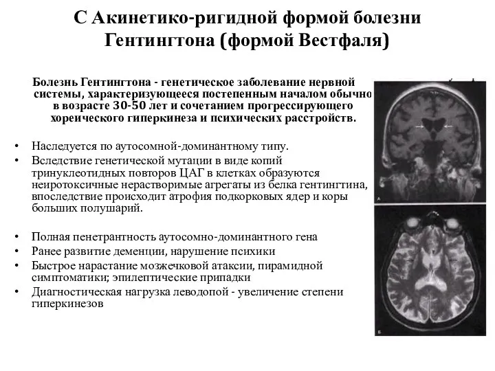 С Акинетико-ригидной формой болезни Гентингтона (формой Вестфаля) Болезнь Гентингтона -