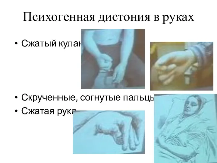 Психогенная дистония в руках Сжатый кулак Скрученные, согнутые пальцы Сжатая рука