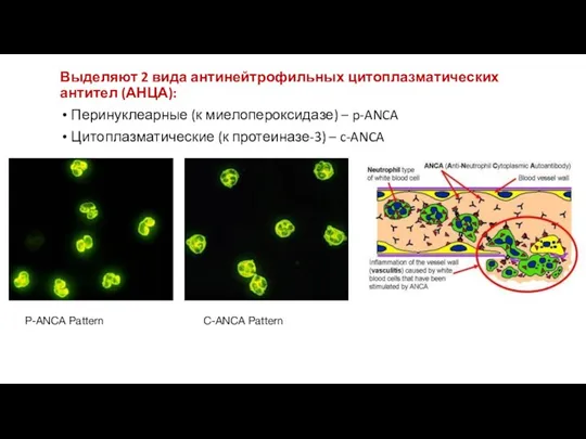 Выделяют 2 вида антинейтрофильных цитоплазматических антител (АНЦА): Перинуклеарные (к миелопероксидазе)
