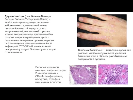 Дерматомиозит (син. болезнь Вагнера, болезнь Вагнера-Унферрихта-Хеппа) – тяжёлое прогрессирующее системное