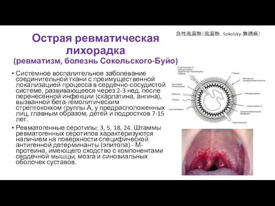 Острая ревматическая лихорадка (ревматизм, болезнь Сокольского-Буйо) Системное воспалительное заболевание соединительной