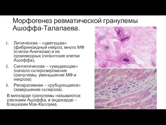 Морфогенез ревматической гранулемы Ашоффа-Талалаева. Литическая – «цветущая» (фибриноидный некроз, много