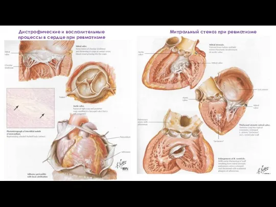Дистрофические и воспалительные процессы в сердце при ревматизме Митральный стеноз при ревматизме