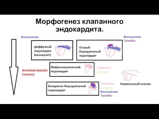 Морфогенез клапанного эндокардита.