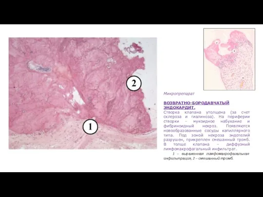 Микропрепарат ВОЗВРАТНО-БОРОДАВЧАТЫЙ ЭНДОКАРДИТ. Створка клапана утолщена (за счет склероза и