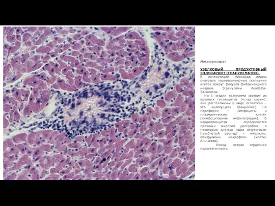 Микропрепарат УЗЕЛКОВЫЙ ПРОДУКТИВНЫЙ ЭНДОКАРДИТ (ГРАНУЛЕМАТОЗ). В интерстиции миокарда видны очаговые