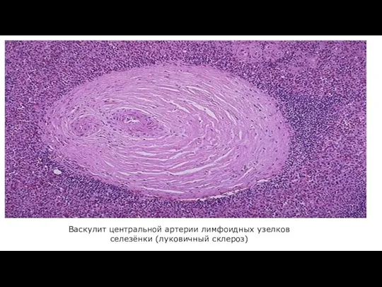 Васкулит центральной артерии лимфоидных узелков селезёнки (луковичный склероз)