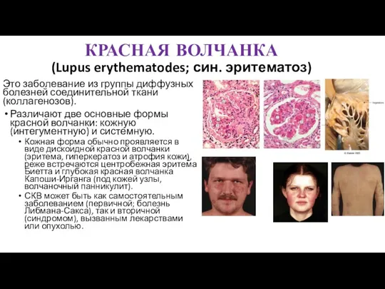 КРАСНАЯ ВОЛЧАНКА (Lupus erythematodes; син. эритематоз) Это заболевание из группы