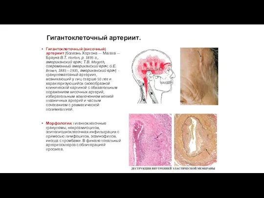 Гигантоклеточный артериит. Гигантоклеточный (височный) артериит (болезнь Хортона — Магата —