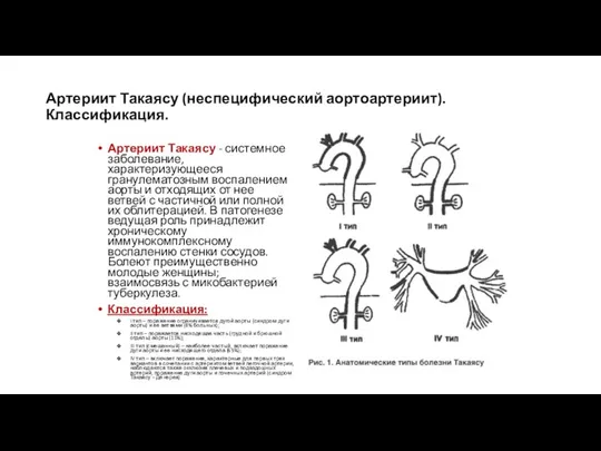 Артериит Такаясу (неспецифический аортоартериит). Классификация. Артериит Такаясу - системное заболевание,