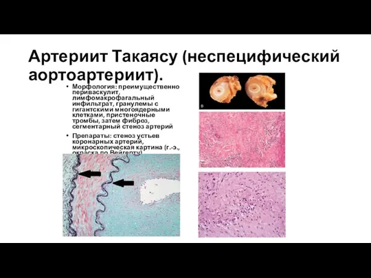 Артериит Такаясу (неспецифический аортоартериит). Морфология: преимущественно периваскулит, лимфомакрофагальный инфильтрат, гранулемы