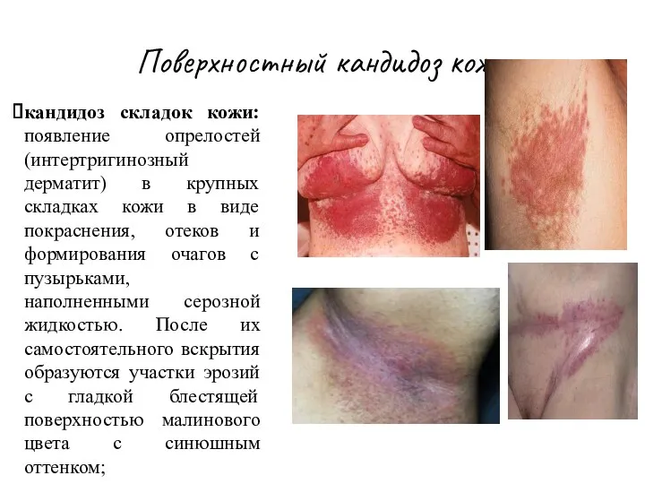 Поверхностный кандидоз кожи кандидоз складок кожи: появление опрелостей (интертригинозный дерматит) в крупных складках