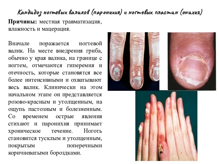 Кандидоз ногтевых валиков (паронихия) и ногтевых пластин (онихия) Причины: местная травматизация, влажность и