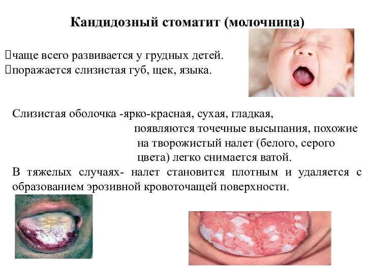 Кандидозный стоматит (молочница) чаще всего развивается у грудных детей. поражается слизистая губ, щек,
