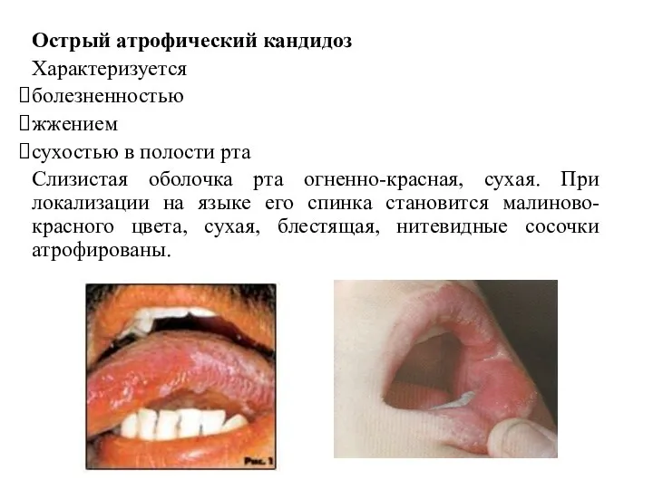 Острый атрофический кандидоз Характеризуется болезненностью жжением сухостью в полости рта Слизистая оболочка рта