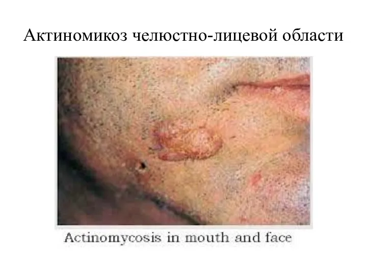 Актиномикоз челюстно-лицевой области
