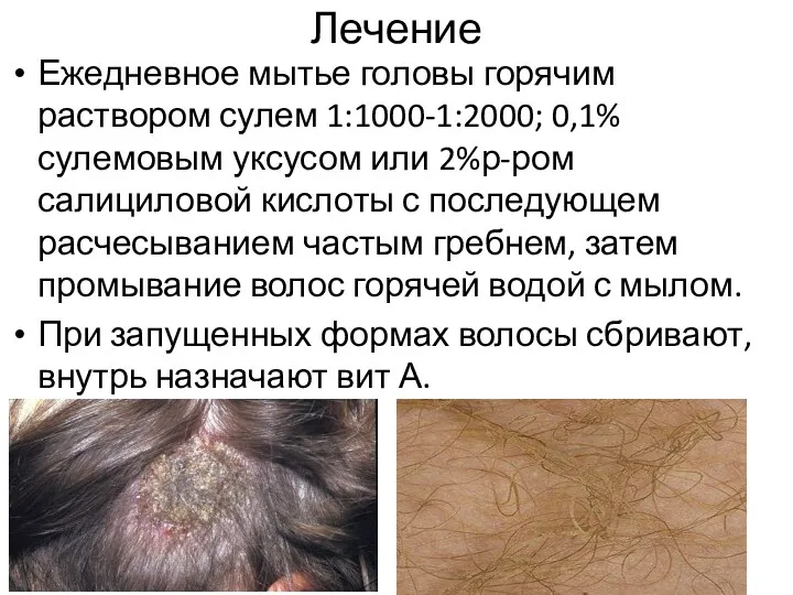 Лечение Ежедневное мытье головы горячим раствором сулем 1:1000-1:2000; 0,1% сулемовым уксусом или 2%р-ром
