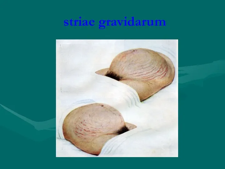 striae gravidarum
