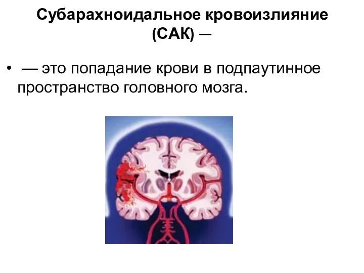 Субарахноидальное кровоизлияние (САК) — — это попадание крови в подпаутинное пространство головного мозга.