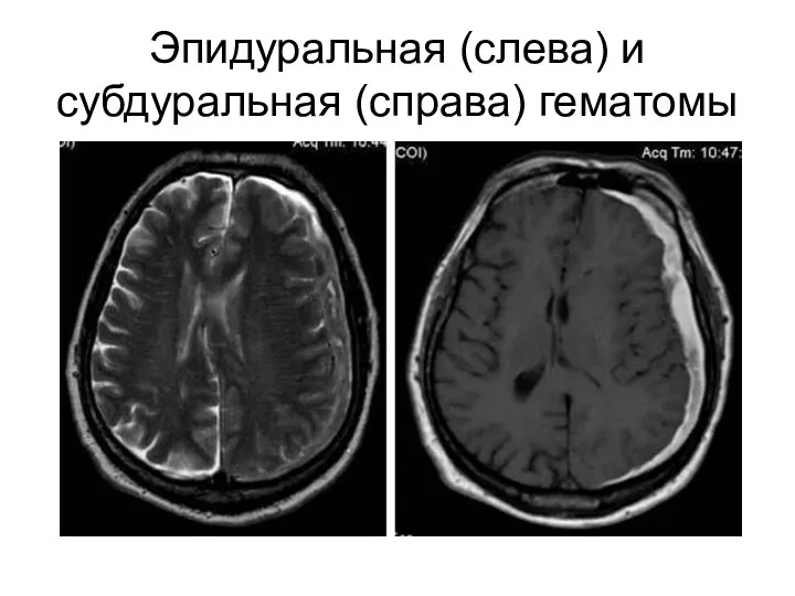 Эпидуральная (слева) и субдуральная (справа) гематомы