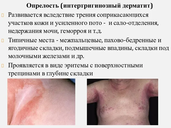Опрелость (интертригинозный дерматит) Развивается вследствие трения соприкасающихся участков кожи и