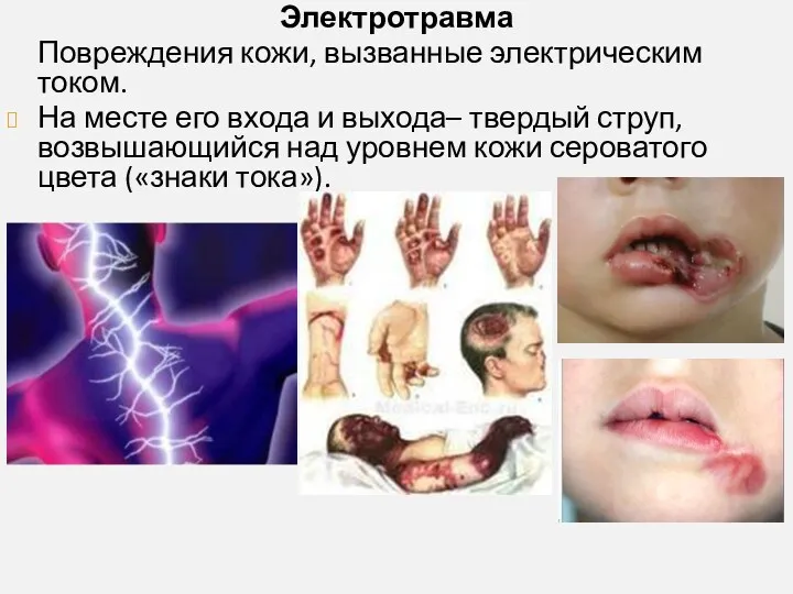 Электротравма Повреждения кожи, вызванные электрическим током. На месте его входа