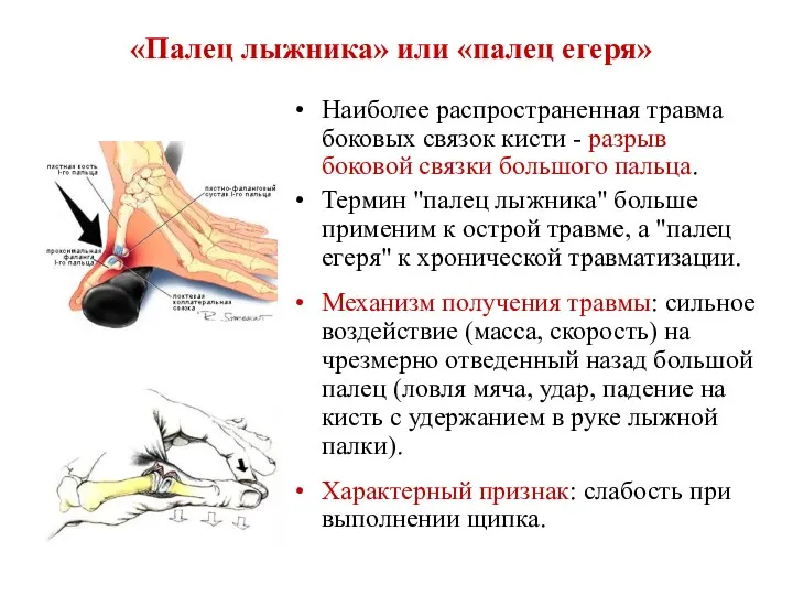 «Палец лыжника» или «палец егеря» Наиболее распространенная травма боковых связок кисти - разрыв