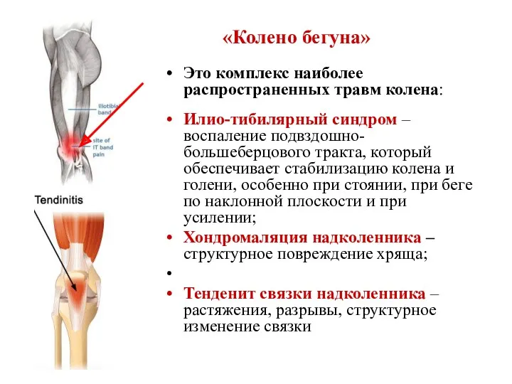 «Колено бегуна» Это комплекс наиболее распространенных травм колена: Илио-тибилярный синдром – воспаление подвздошно-большеберцового