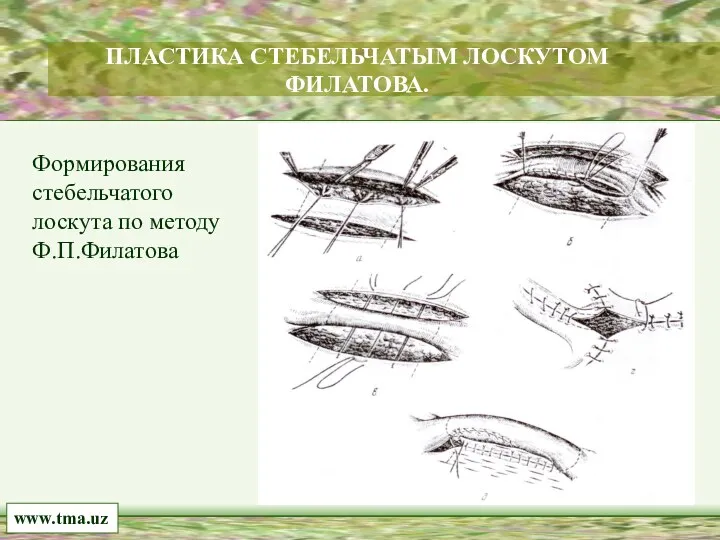 www.tma.uz ПЛАСТИКА СТЕБЕЛЬЧАТЫМ ЛОСКУТОМ ФИЛАТОВА. Формирования стебельчатого лоскута по методу Ф.П.Филатова