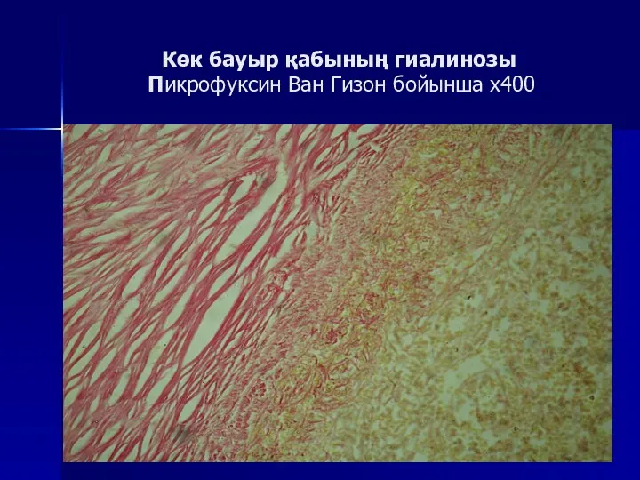 Көк бауыр қабының гиалинозы Пикрофуксин Ван Гизон бойынша х400