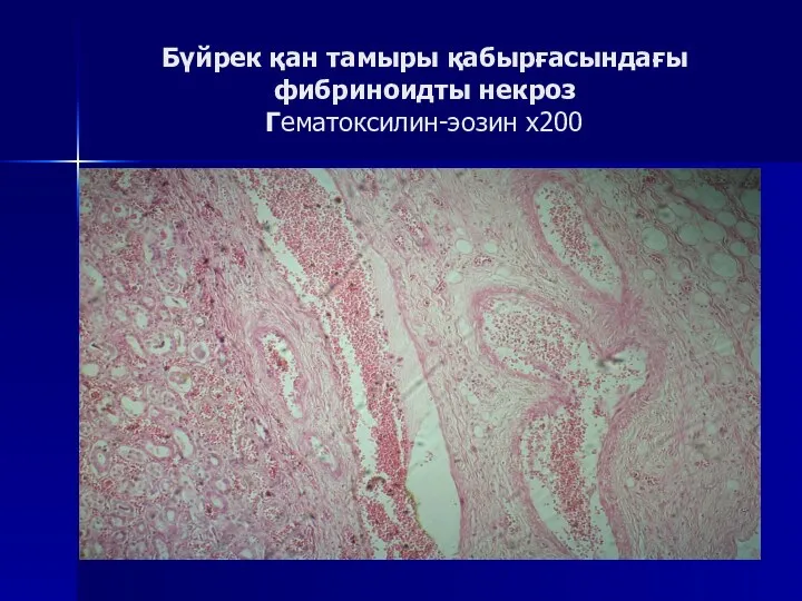 Бүйрек қан тамыры қабырғасындағы фибриноидты некроз Гематоксилин-эозин х200
