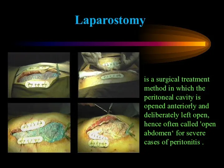 Laparostomy is a surgical treatment method in which the peritoneal