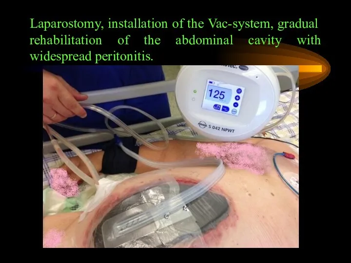 Laparostomy, installation of the Vac-system, gradual rehabilitation of the abdominal cavity with widespread peritonitis.