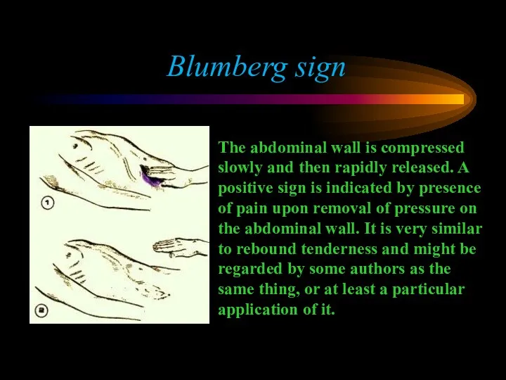 Blumberg sign The abdominal wall is compressed slowly and then