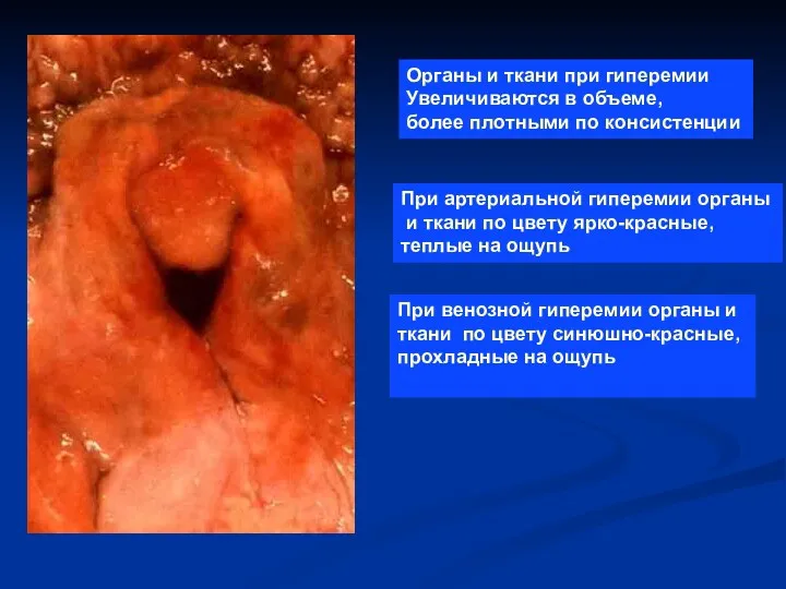 Органы и ткани при гиперемии Увеличиваются в объеме, более плотными по консистенции При