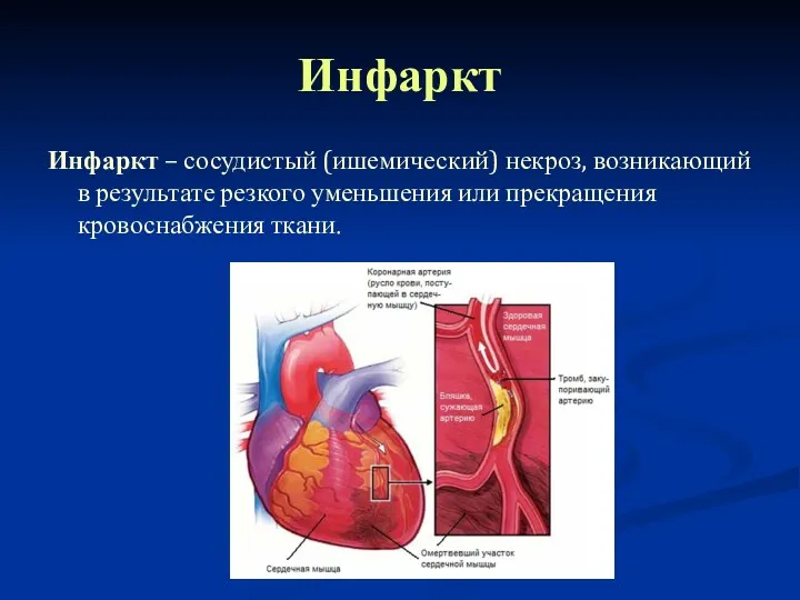 Инфаркт Инфаркт – сосудистый (ишемический) некроз, возникающий в результате резкого уменьшения или прекращения кровоснабжения ткани.