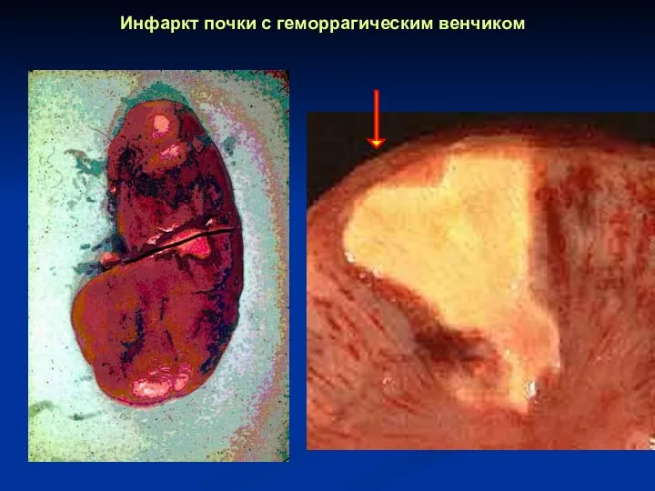 Инфаркт почки с геморрагическим венчиком