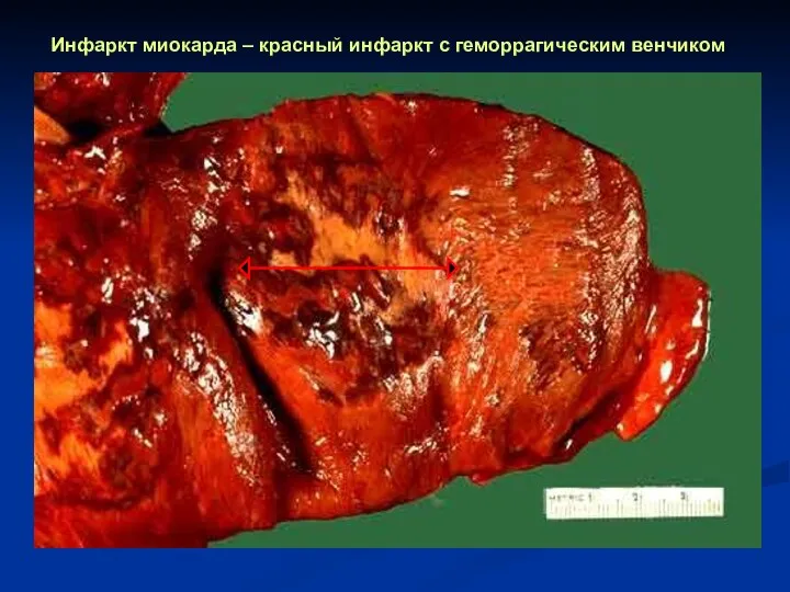 Инфаркт миокарда – красный инфаркт с геморрагическим венчиком