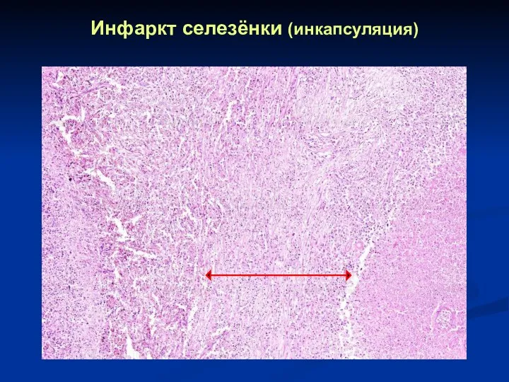 Инфаркт селезёнки (инкапсуляция)