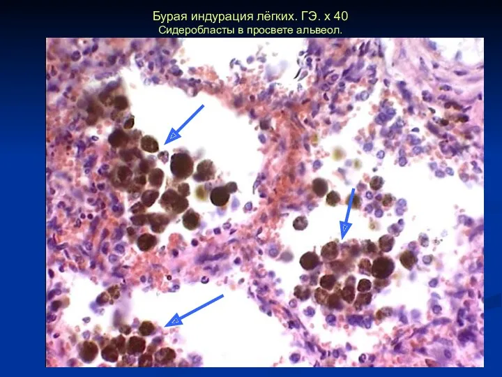 Бурая индурация лёгких. ГЭ. х 40 Сидеробласты в просвете альвеол.