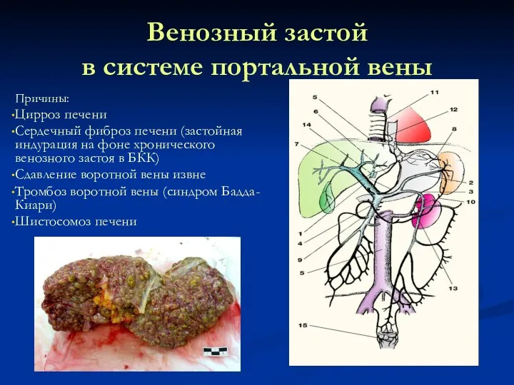 Венозный застой в системе портальной вены Причины: Цирроз печени Сердечный фиброз печени (застойная