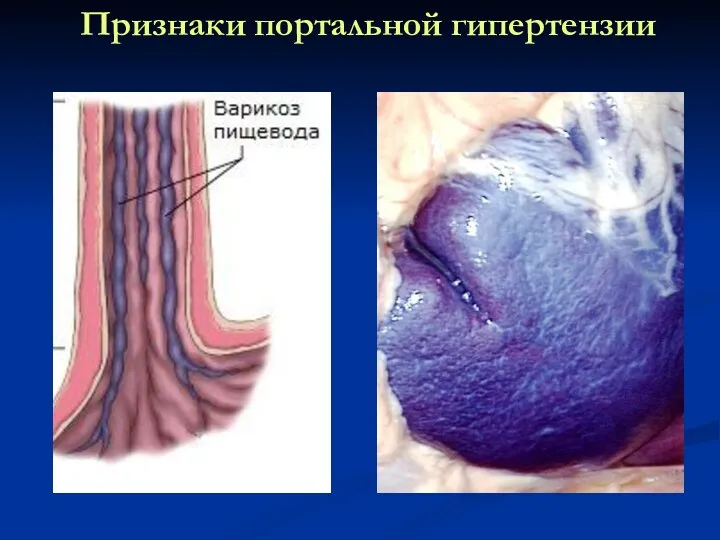 Признаки портальной гипертензии