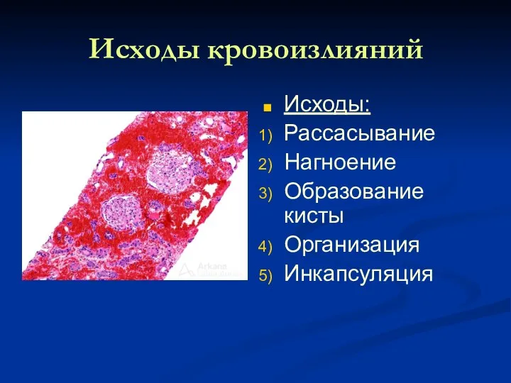 Исходы кровоизлияний Исходы: Рассасывание Нагноение Образование кисты Организация Инкапсуляция