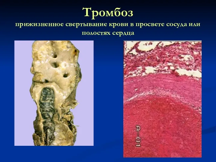 Тромбоз прижизненное свертывание крови в просвете сосуда или полостях сердца